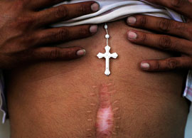 Joel Féliz de Jesus shows the scars on his abdomen following emergency surgery from blunt trauma to his internal organs allegedly inflicted by a group of Puerto Rican police.