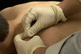 A patient receives a dry needling treatment.