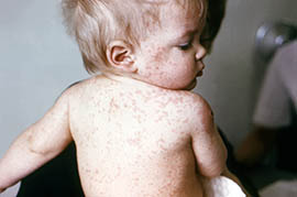 This photo from the 1960s shows a child with measles. Vaccinations have largely controlled measles and many other diseases, but Maricopa County officials are worried about a possible outbreak of measles after a person found later to be infected visited several crowded areas.