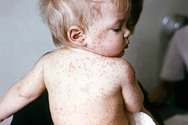 This photo from the 1960s shows a child with measles. Vaccinations have largely controlled measles and many other diseases, but recent cases and exposures in Arizona have put those who aren’t vaccinated at risk.